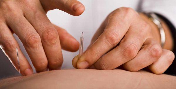acupuncture