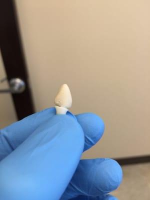 Open margin. Worst looking temp I've ever seen. Wouldn't pass for a 1st year dental student