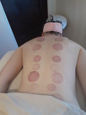Cupping Therapy for relaxation and muscle tension relief