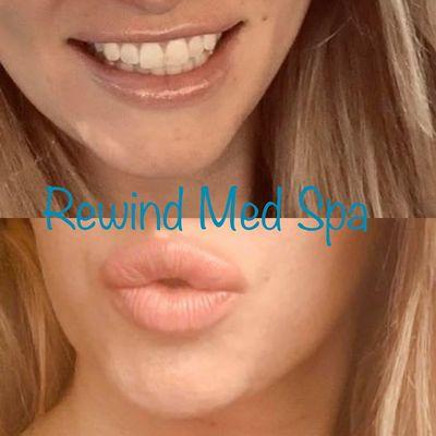 Lip Filler Injection