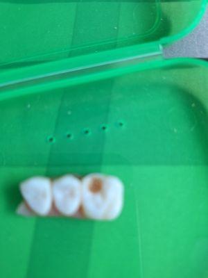 temporary implants broken again and I can't eat. Dr Herzog refuses to repair her mistakes. Deep Depression from 2 years not eating solids.