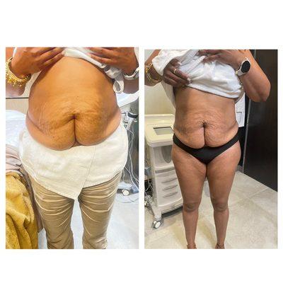 Meso therapy for fat dissolve