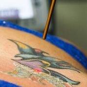 Evanesce Laser Tattoo Removal