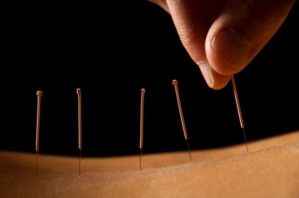 Perfect Point Acupuncture