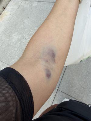 Do not recommend going to this location. I had my blood drawn yesterday and this is the result.