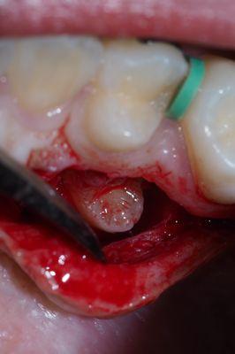 Oral and Dentoalveolar surgery