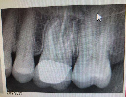My root canal