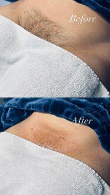 Before and Afters of a Brazilian Wax