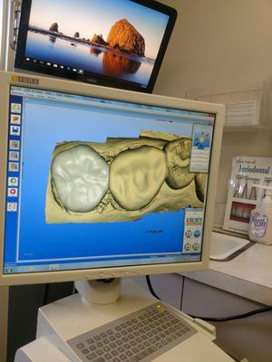 CAD imaging work of my dental crown
