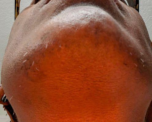 Electrolysis by Debra