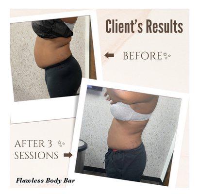 Real Results! What body goals can Flawless help you achieve? No downtime and no pain. Cavitation and Rf skin tightening