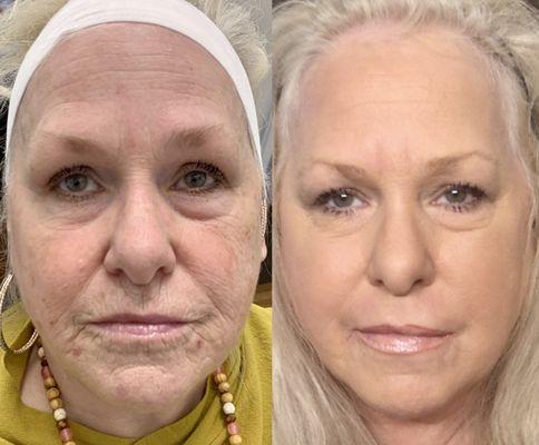 Erbium Laser before and after performed by Dr Grisoli