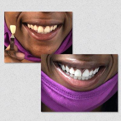 What's under your mask??
(Results from our 80-Minute Treatment)