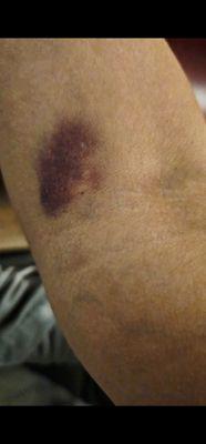 My dr.is good person but in lab woman there is harsh and look like she dont want to work there she turn around needle inside my skin.