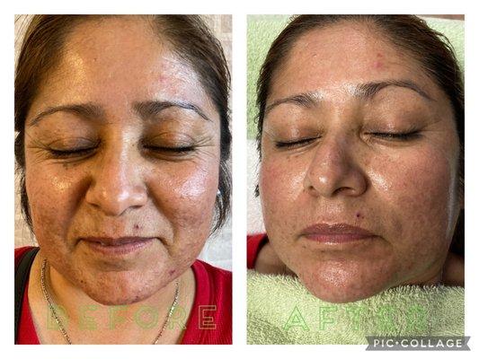 High acne prone skin facial