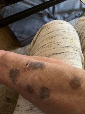 Bruised all over arm
