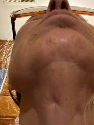 Indentions are scars from the drain holes. These drain holes were incredibly painful when they had to periodically clean them out.