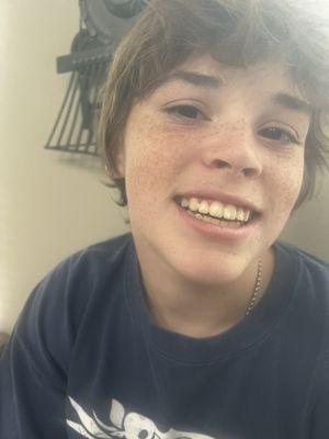 Before and after braces