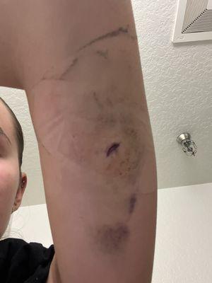 Open incision from nexplanon removal