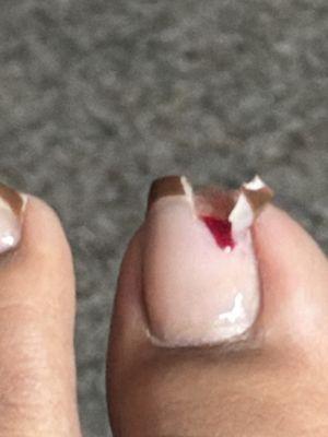 Toe nail broken