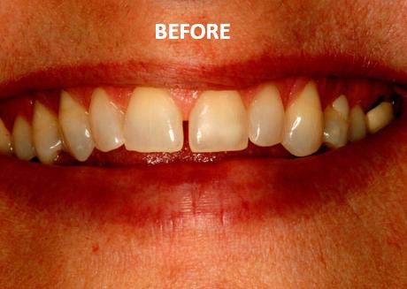 Smile change - Before