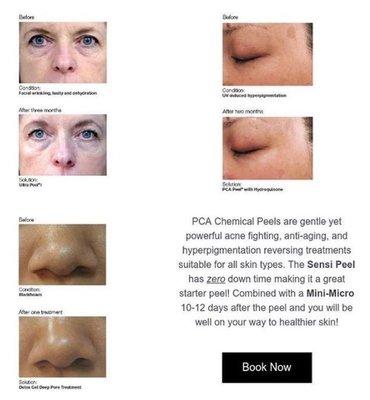 PCA Sensi Peels are suitable for all skin types, mention this ad for a FREE starter kit!