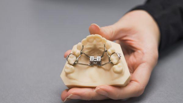 An example of a Rapid Palatal Expander "RPE"