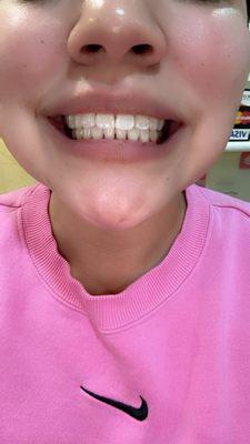 6 month dental cleaning