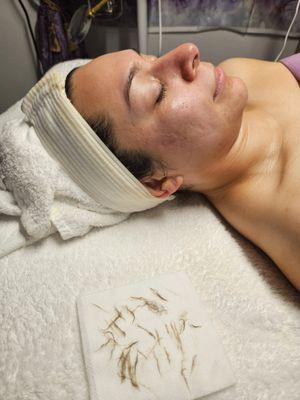 Post dermaplane with peachfuzz removed showing on esthetic wipe