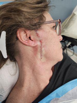 Day of melanoma procedure & photo 2 was. Later