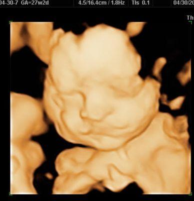 Angel Vision 3D/4D Ultrasound