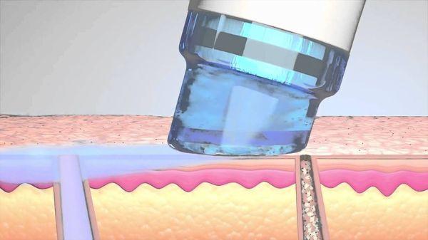 Take your skincare to the next level...Hydrofacial Treatment