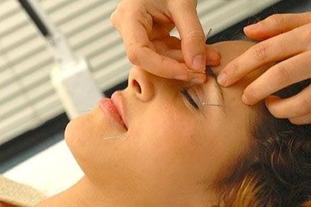 facial rejuvenation acupuncture
