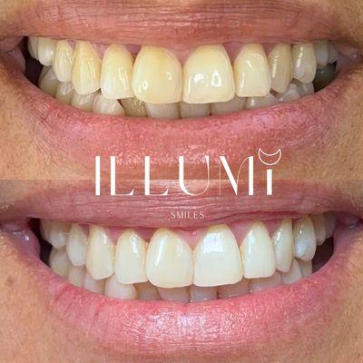 Illumi Smiles