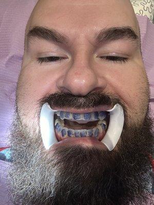 Advanced Laser Dentistry