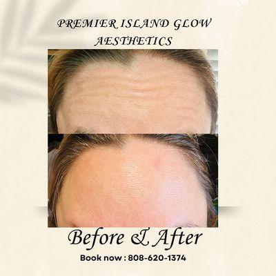 Beautiful, natural results with Daxxify