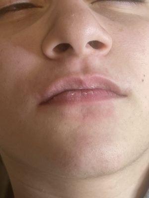 Upper and lower lips