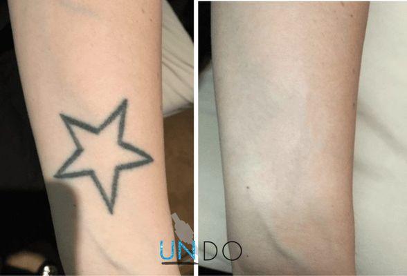 Tattoo removal without Laser! Safer for the skin and lifting unwanted ink.