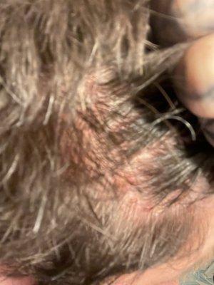 Shingles on right of head