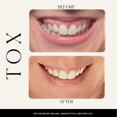 Before and after of Botox injections to treat gummy smile
