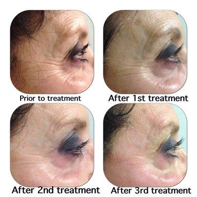 Micronnedling treatments .