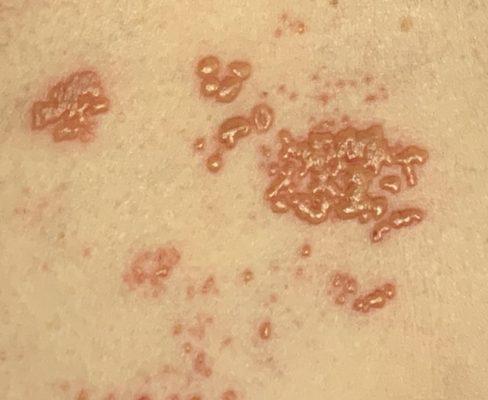 this is NOT Sciatica it's SHINGLES!