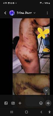 Liposuction hematoma seroma stroke nerve damage spine damage I'm on disability