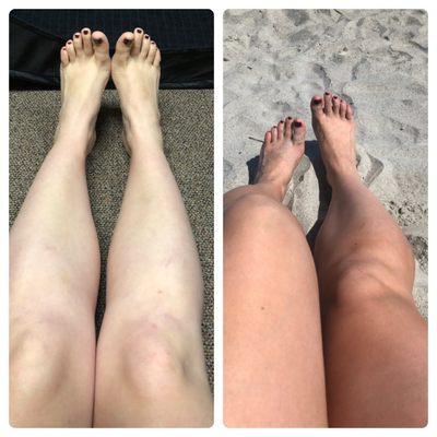 My legs before and after