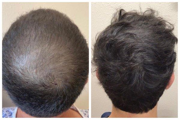 La Mesa Medical Hair Restoration