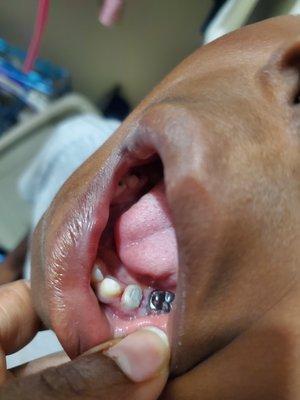 The latest cap that fell out came from here. Notice his gums are cut as well!