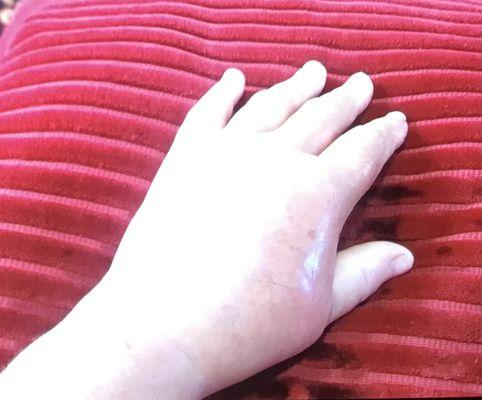 My swollen hand getting worse w/o antibiotic