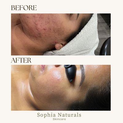 Another great skincare transformation