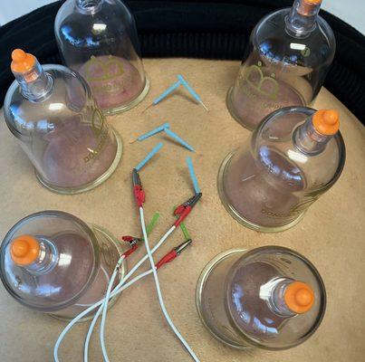 Low Back Pain Acupuncture treatment