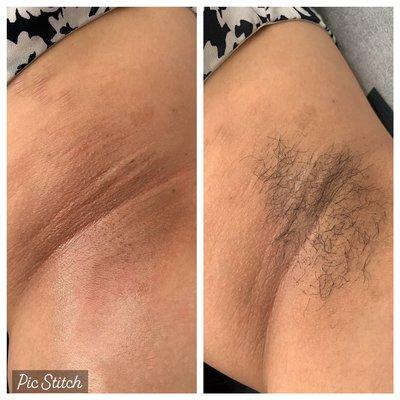 Under Arm Waxing.